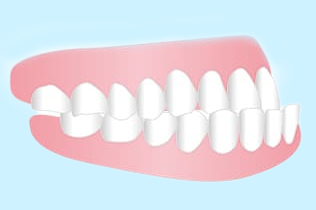 受け口、下顎前突、しゃくれ、反対咬合