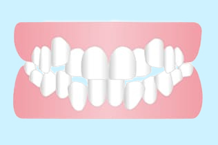 叢生、乱杭歯、八重歯