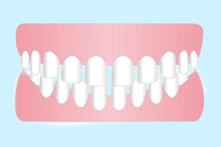 すきっ歯（空隙歯列弓）