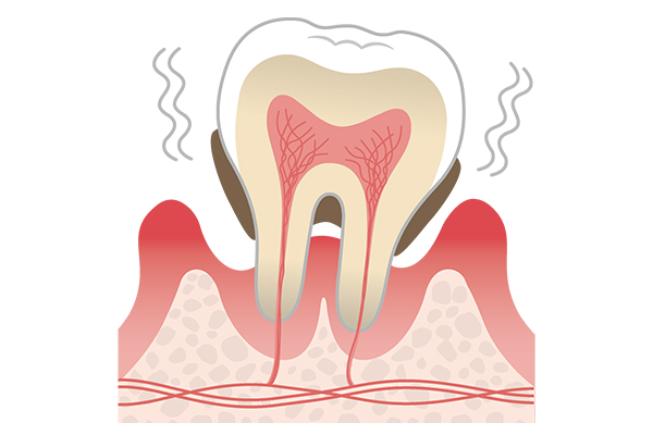 歯の根の病気の種類